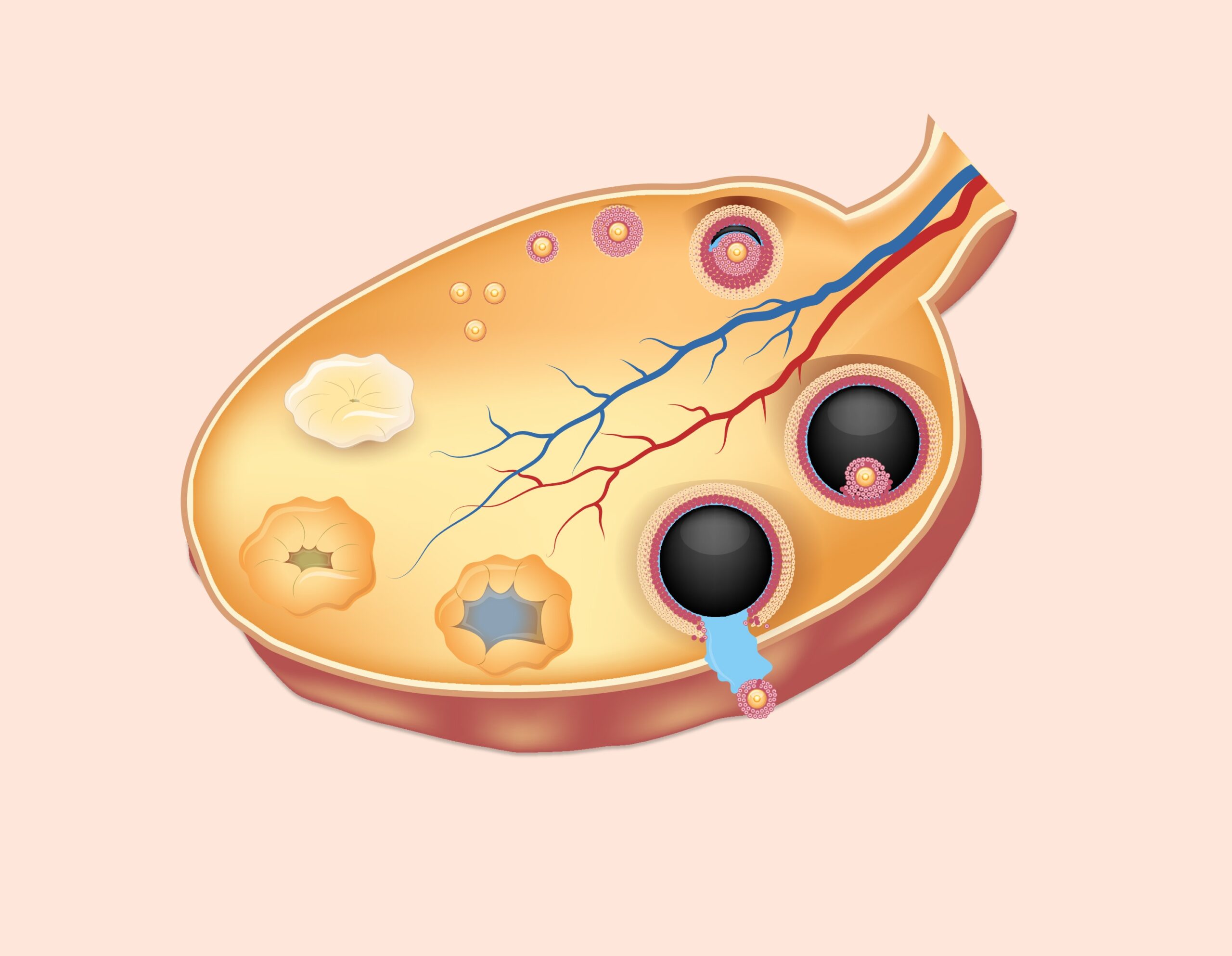 Ovaires | opération utérus ovaires | Gynécologie obstétrique et infertilité| Dr Krief | Paris